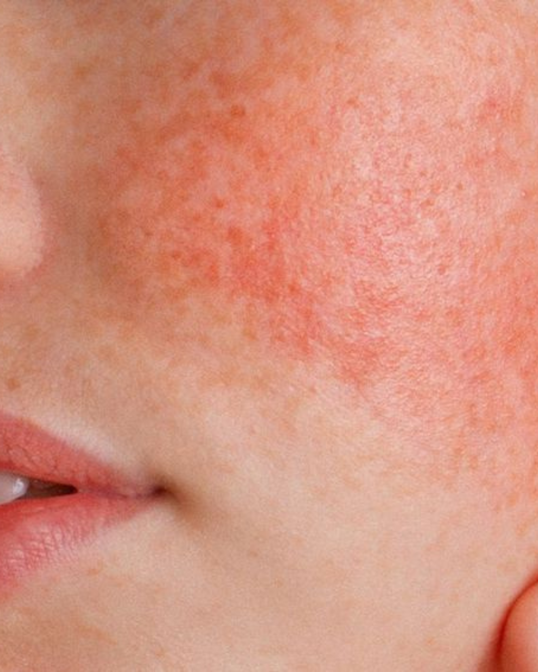 Pharmaceris R – Trajtim Efektiv për Rosacea dhe Lëkurë të Irrituar | Amar.al