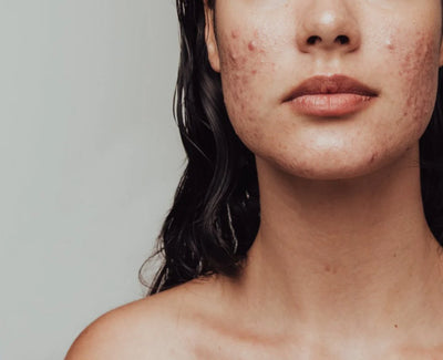 Lëkurë me njolla dhe akne të rënda