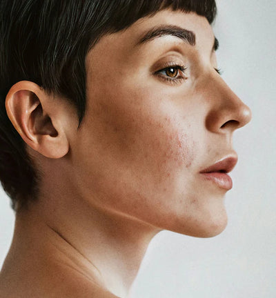 Lëkurë e ngjeshur dhe me yndyrë