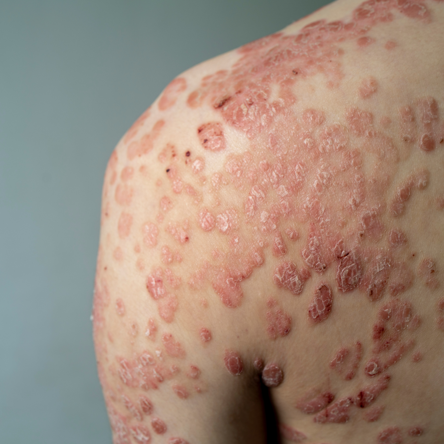Pharmaceris P – Trajtimi i Psoriazës Qetësim dhe Hidrim