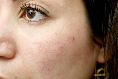 Lëkurë e ndjeshme, e inflamuar dhe me skuqje