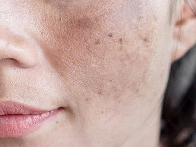 Melazma sipërfaqësore ose njolla me ngjyra dhe më të errëta